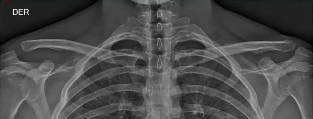 radiografia clavicula
