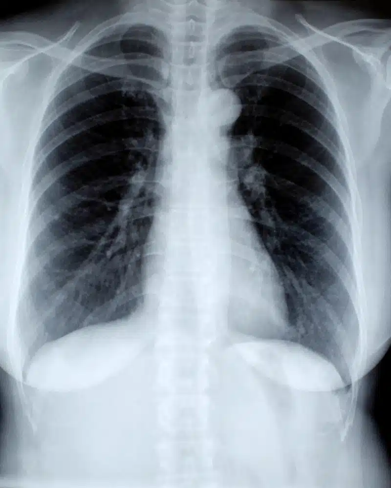 radiografia del corazon