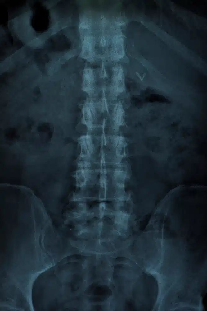 https://benetampico.cirugiacardiovascular.com.mx/wp-content/uploads/2023/09/rayos-x-columna-vertebral.webp